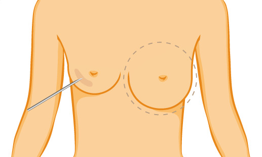 schrittweise Brustvergrößerung mit Hyaluronsäure