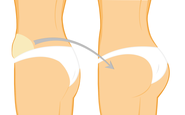 Bbl Op . Brazilian Butt Lift Mit Fetttransfer Zu Povergrosserung Und Sanduhrfigur Lipocenter